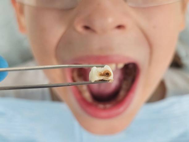 Best Knocked-Out Tooth (Avulsed Tooth) Treatment in East Riverdale, MD